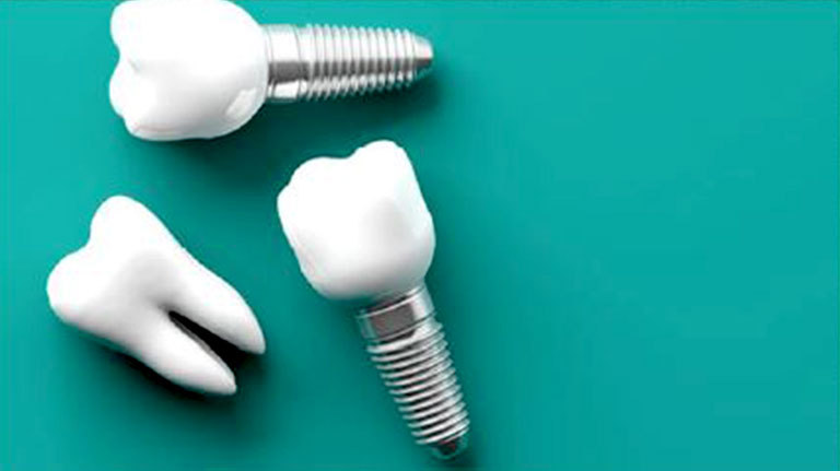 بهترین نوع ایمپلنت دندان