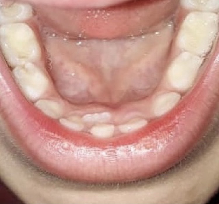 رویش دندان اصلی