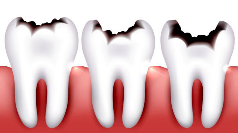 پوسیدگی دندان