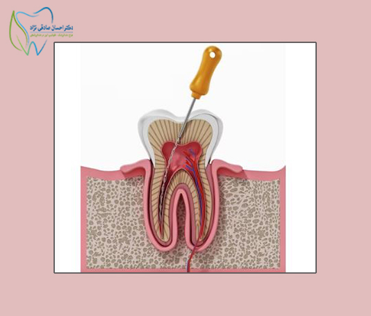 درمان ریشه