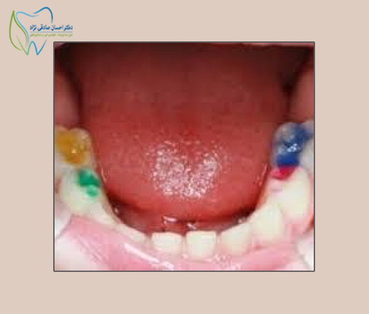 کامپوزیت رنگی