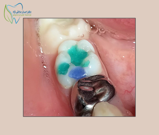 کامپوزیت رنگی