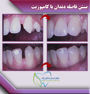 بستن-فاصله-دندان-با-کامپوزیت-1-1