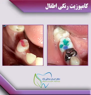 کامپوزیت-رنگی-کودکان