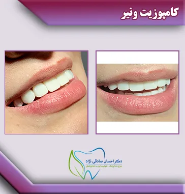 کامپوزیت-ونیر1-2