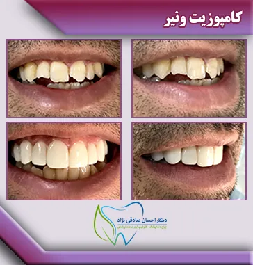 کامپوزیت-ونیر4