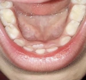 رویش دندان اصلی